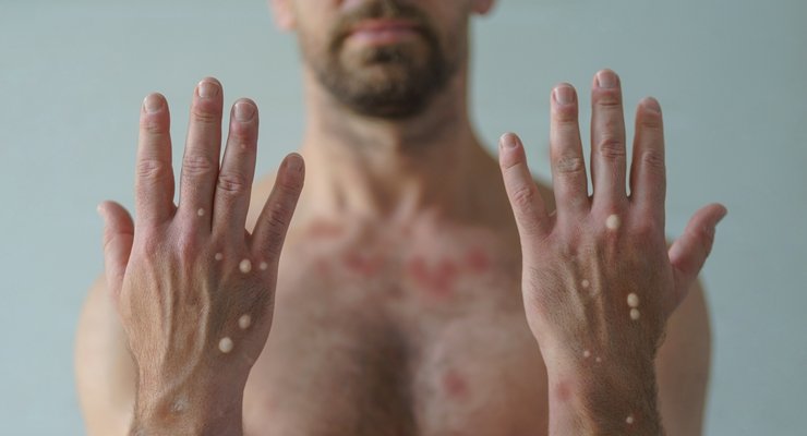 Los Angeles County Reports First Locally Transmitted Clade I Mpox Case